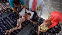 Xót xa những đứa trẻ suy dinh dưỡng giữa vùng chiến Gaza