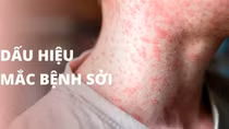 Nhiều người lớn sốt cao nhưng không biết bị mắc sởi nặng
