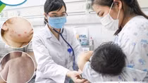Trẻ sơ sinh bị thuỷ đậu biến chứng viêm phổi, suy hô hấp, cha mẹ không được chủ quan