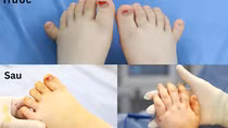 Phẫu thuật thành công cho em bé có đến 24 ngón tay chân hiếm gặp