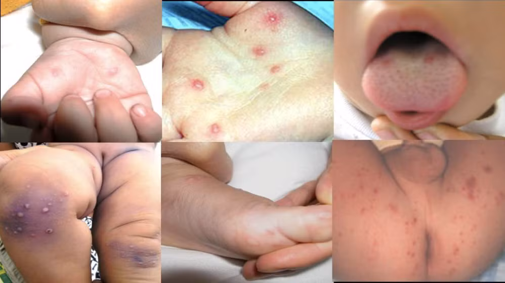 Cảnh báo dịch chồng dịch – tay chân miệng và sốt xuất huyết -0