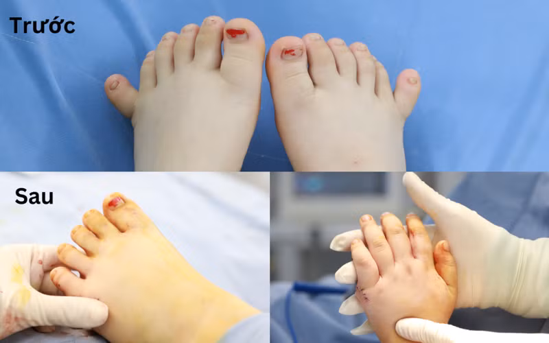 Phẫu thuật thành công cho em bé dị tật 24 ngón tay chân hiếm gặp -0
