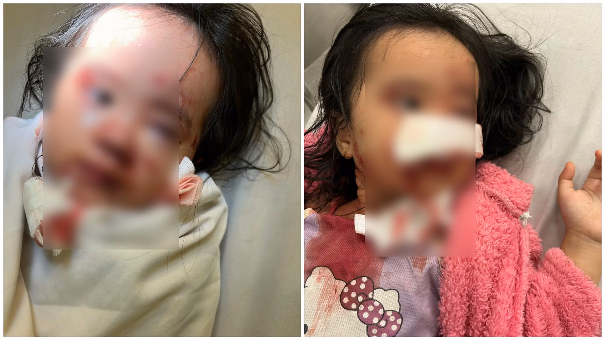 Bé gái 5 tuổi bị chó cắn gây thương tích nặng ở mặt khi chơi trong công viên -0