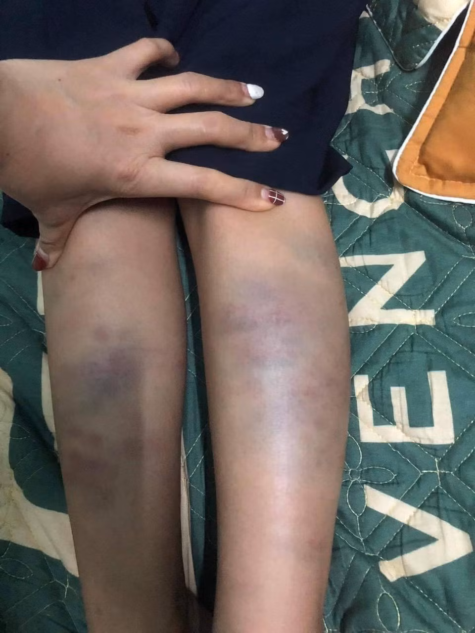 Sở GD&ĐT Đà Nẵng: Đề nghị tạm thời không để giáo viên chủ nhiệm đứng lớp vụ học sinh lớp 1 bị đánh -0