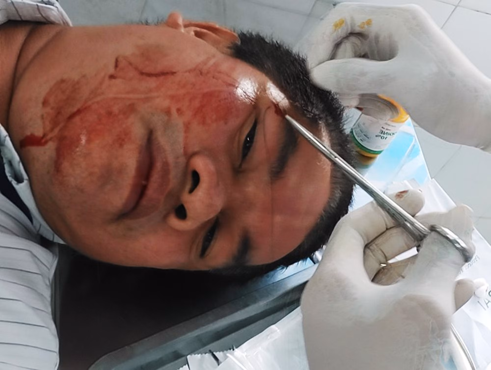 Khởi tố đối tượng đánh cán bộ xã Long Sơn, TP Vũng Tàu -0