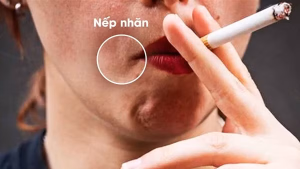 Hút thuốc lá làm tăng quá trình lão hoá, sớm xuất hiện các nếp nhăn