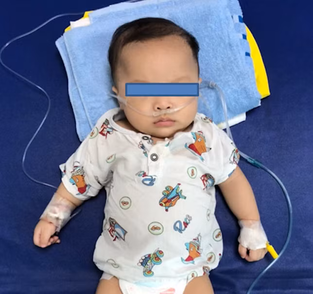 Bệnh nhi mắc bệnh hiếm gặp của Thế giới: viêm thanh quản suy hô hấp cấp do COVID-19 -0