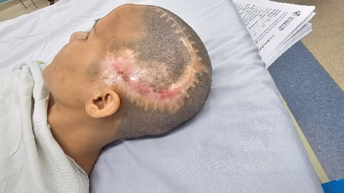 Phẫu thuật thành công trường hợp sẹo rộng vùng khuyết sọ sau biến chứng thẩm mỹ -0