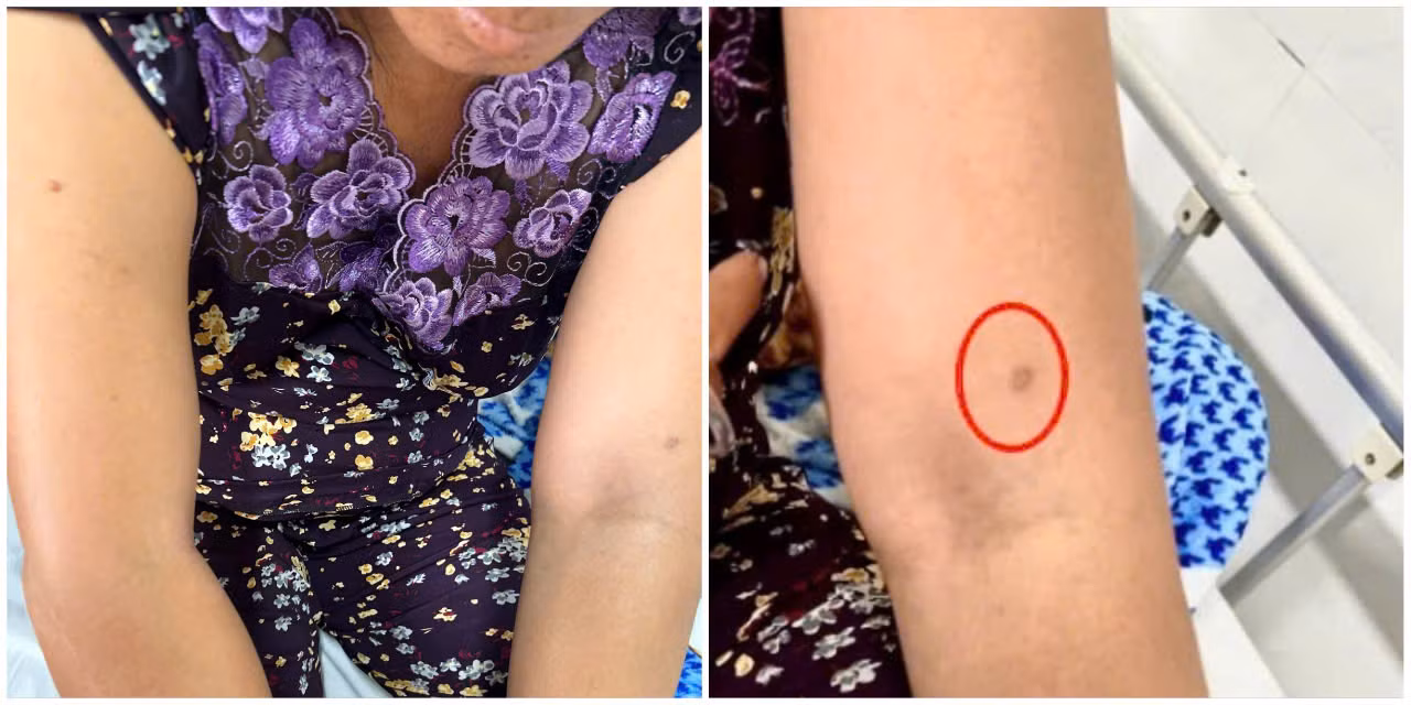 Cảnh báo liên tục nhiều trường hợp sốc phản vệ do ong vò vẽ đốt -0