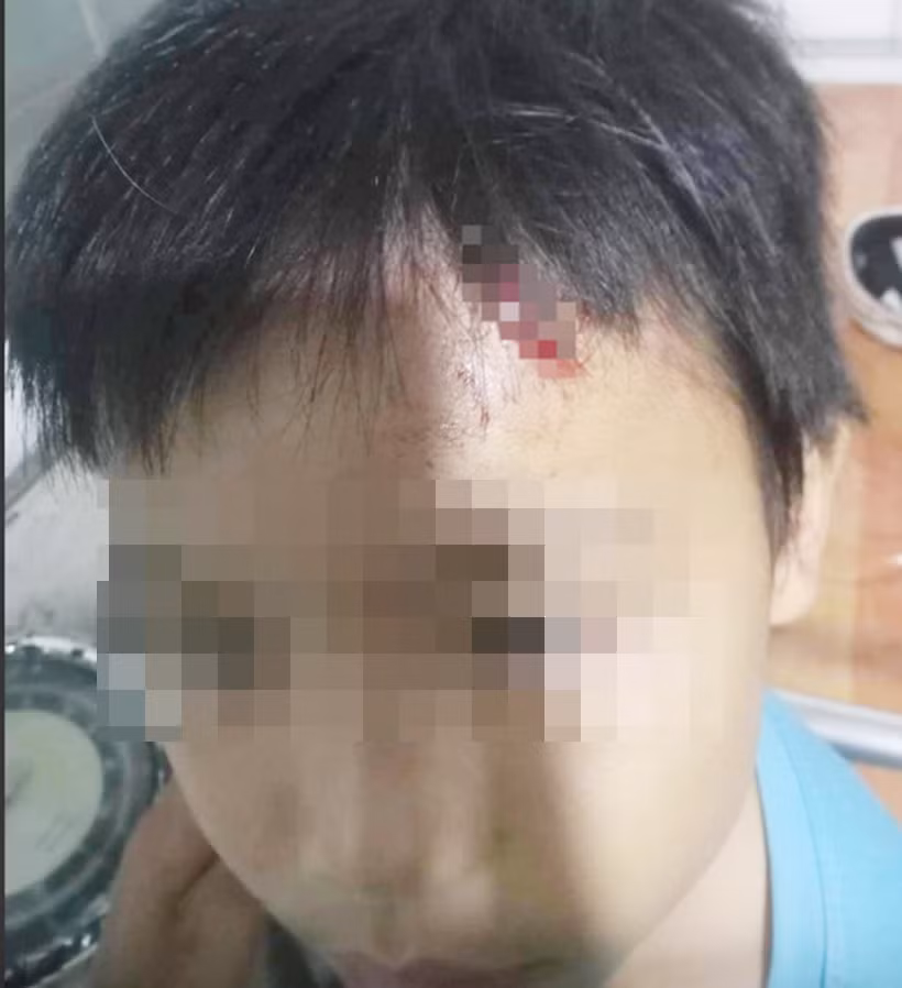 Tỉnh Cà Mau chỉ đạo làm rõ vụ cháu bé từng bị hành hạ nay lại bị bầm người, rách đầu -0