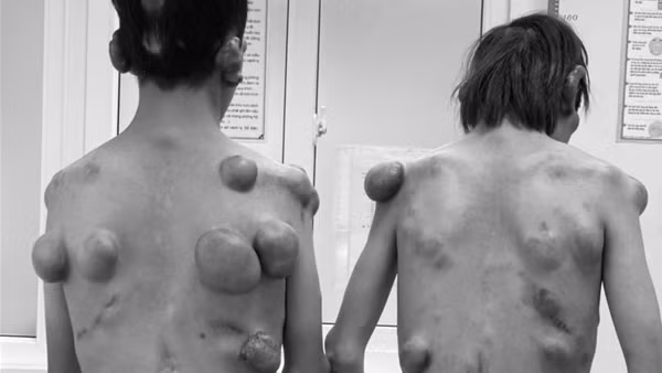 Phẫu thuật cho 2 anh em sinh đôi "người củi" có hàng trăm khối u