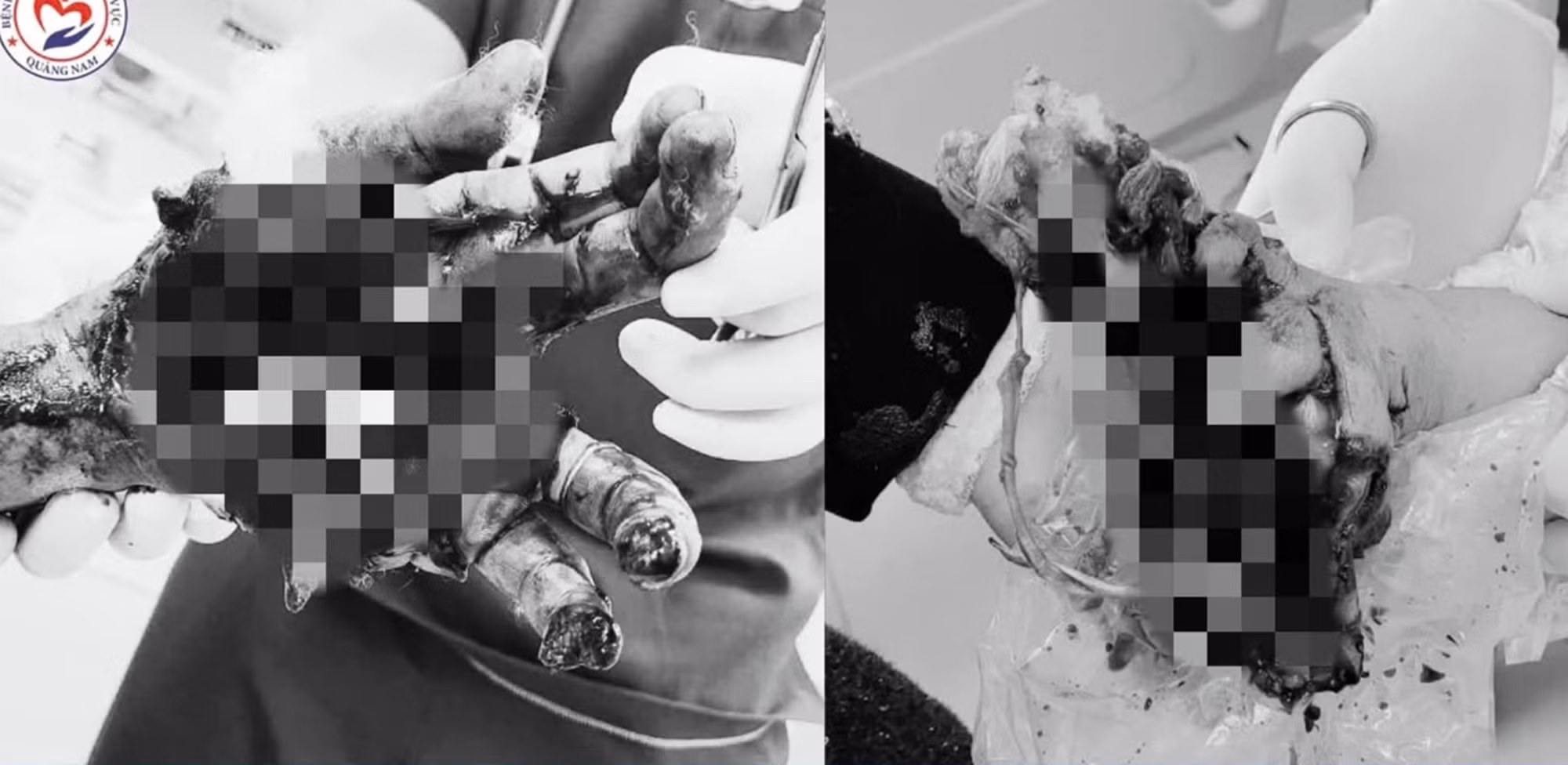 Kịp thời cứu chữa nam thanh niên bị dập nát 2 tay nghi do pháo nổ tự chế -0