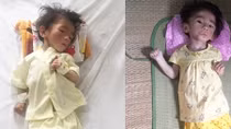 Cháu bé bị suy dinh dưỡng đã được ra viện