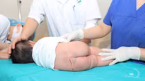 Cắt đuôi bẩm sinh hiếm gặp cho bé gái 5 tháng tuổi
