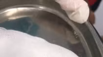 Con vắt dài 3cm sống 1 tháng trong mũi bé trai
