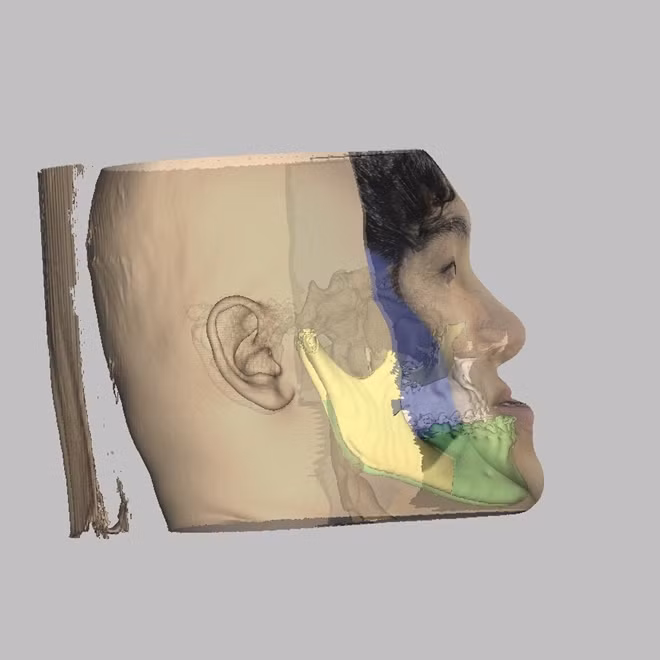 Thiết kế 3D trước mổ