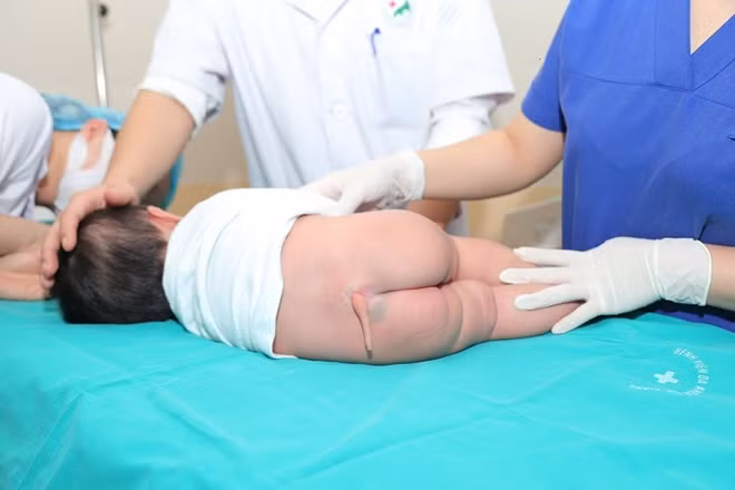 Cháu bé còn đuôi bẩm sinh trước khi phẫu thuật