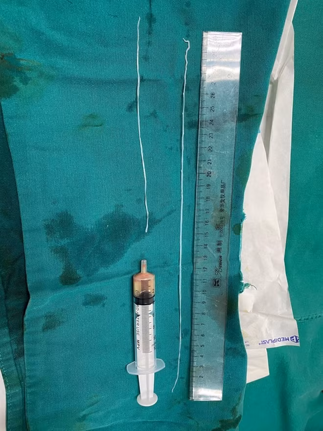 Giun hiếm gặp dài 60cm được lấy ra từ người nam thanh niên 23 tuổi