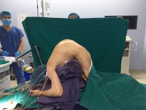 Phẫu thuật cứu bệnh nhân 'siêu gù' 10 năm không thể nằm ngửa