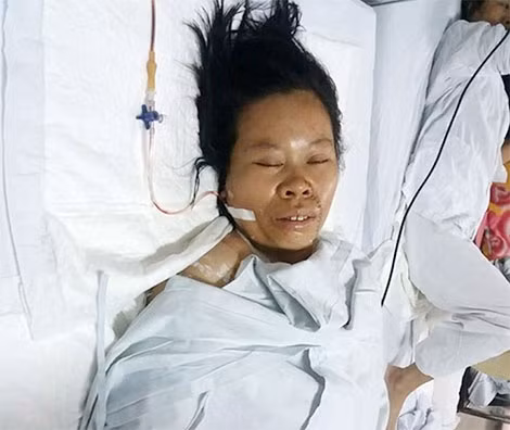 Chị Lương Thị Thiết đang được điều trị tại bệnh viện Việt Đức.