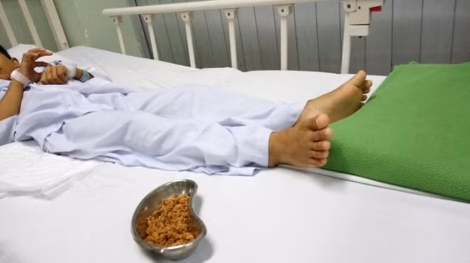 Bệnh nhi P và trên 70g hạt sơ-ri, được các bác sỹ lấy ra từ hậu môn.