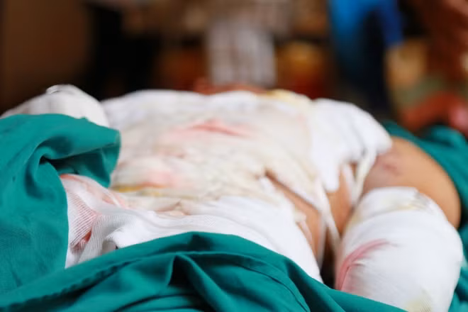 Vụ nổ hy hữu đã làm Hiến bị cụt hẳn 2 tay và đa chấn thương