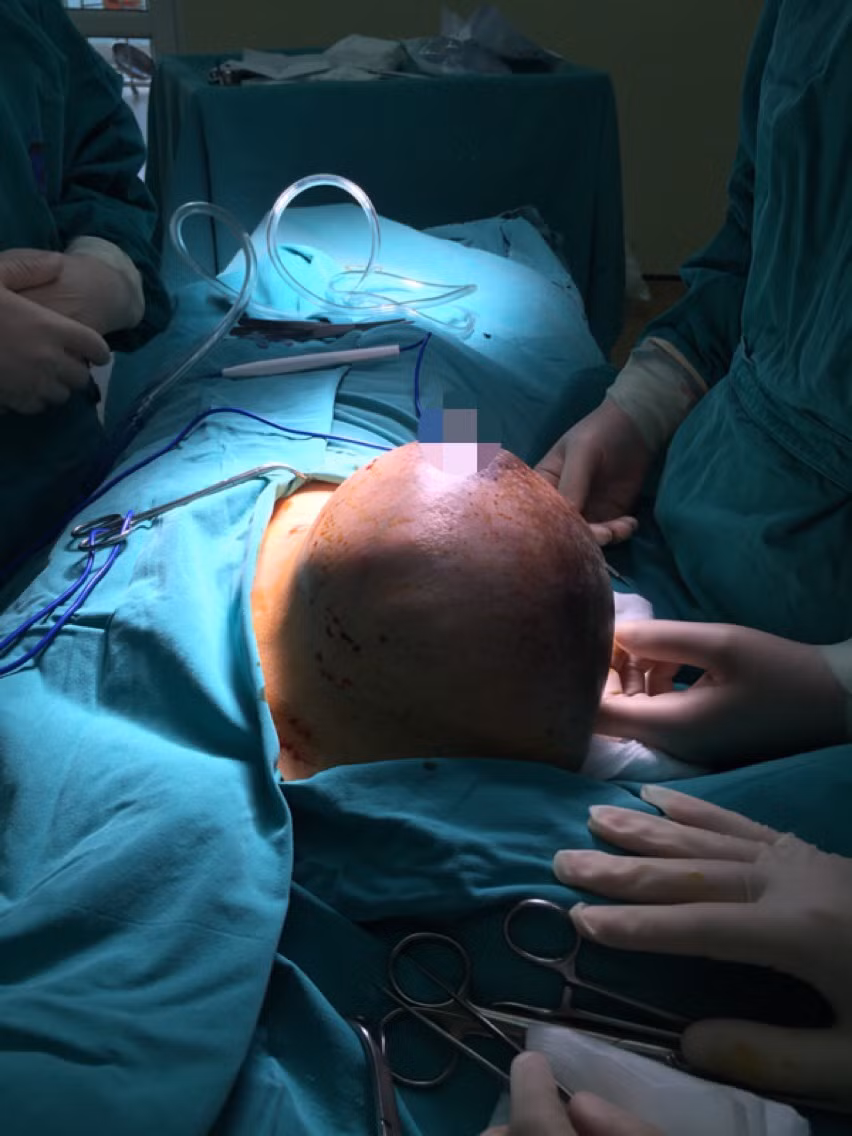 Giúp cô gái 22 tuổi mắc phì đại tuyến vú mức độ trầm trọng bớt mặc cảm ảnh 3