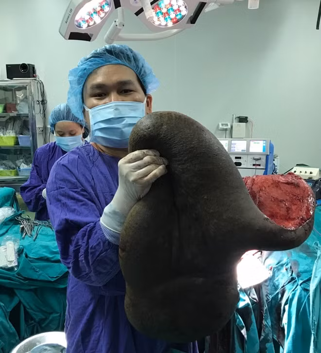 Khối u sau khi được bóc tách khỏi lưng bệnh nhân