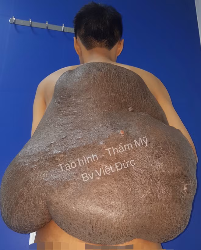 Khối u khổng lồ trên lưng anh Vinh
