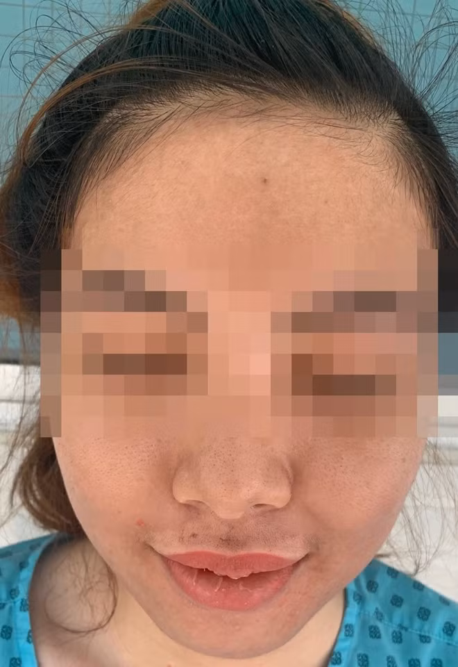 Bệnh nhân đã được xuất viện sau 1 tuần điều trị nhưng vẫn phải theo dõi tiếp tại nhà
