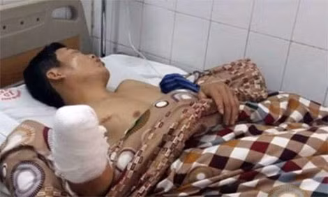Hoàng Văn On đã bị cụt 1 /2 cẳng tay vì tự tay đốt pháo đón giao thừa (1)