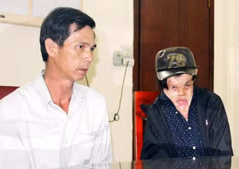 Ngô Quý Hải với khuôn mặt dị dạng do di chứng của bỏng và bố của Hải.