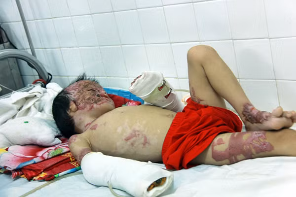 Bé Ngô Công Tuấn Anh với những vết bỏng trên cơ thể.