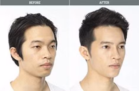 Một thanh niên ở Busan trước (trái) và sau phẫu thuật thẩm mỹ sửa đổi toàn bộ gương mặt.