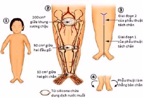 Mô tả hội chứng sirenomelia.