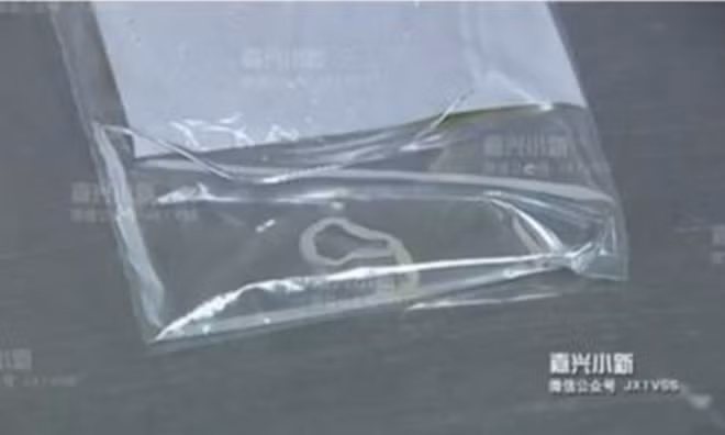 Con sơ mít dài 13cm sau khi được lấy ra từ cơ thể bệnh nhân Diêu. Ảnh: Báo Tin tức Hàng Châu