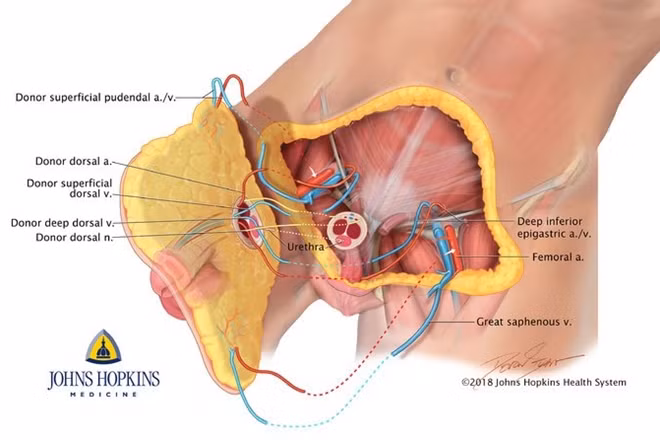 Ca cấy ghép dương vật phức nhất thế giới dành cho cựu chiến binh Mỹ. Ảnh: BV John Hopkins