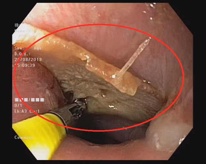 Mảnh xương cá khi còn mắc kẹt tại miệng thực quản