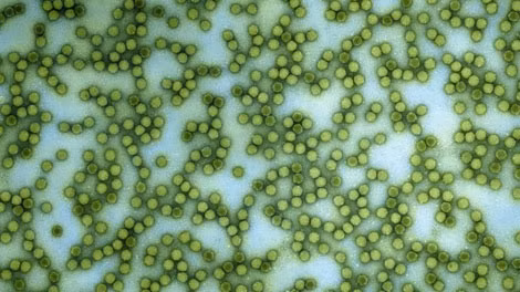 Virus bại liệt.