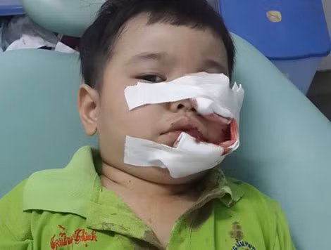 Trường hợp một bé trai bị chó cắn 19 vết rách lớn nhỏ trên mặt.