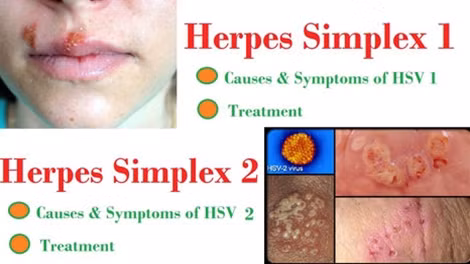Virus herpes gây ra lở loét, mụn rộp.