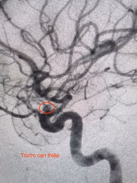 Hình ảnh mạch máu não trước khi can thiệp.