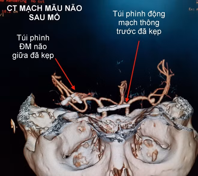 Và sau khi can thiệp thành công.