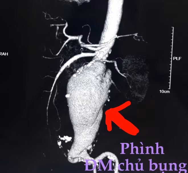 Hình ảnh vỡ túi phình động mạch ở bệnh nhân Sơn.