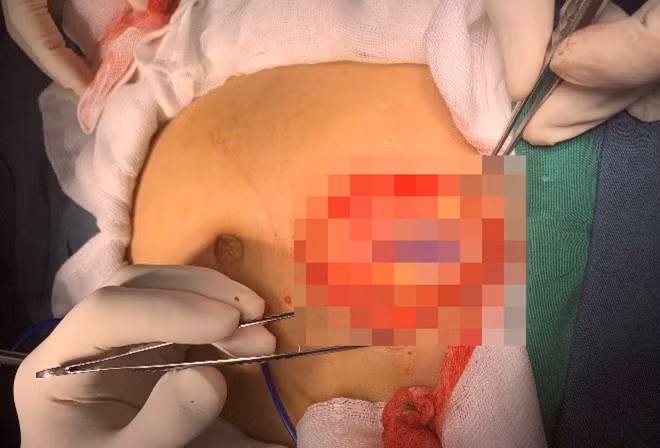 Các BS phẫu thuật cho bệnh nhi T.