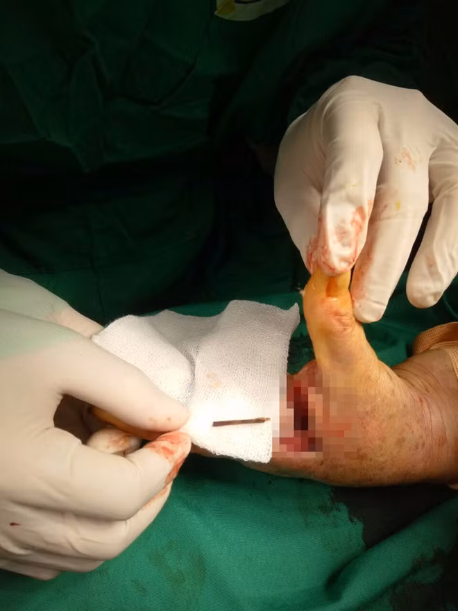 Cọng tàu dừa 2 mm sau 3 năm được phẫu thuật lấy ra khỏi tay bệnh nhân.