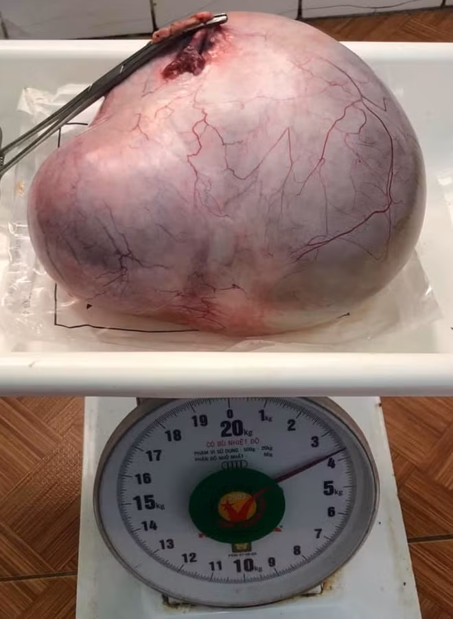 Khối u khổng lồ, nặng 3,7kg được lấy ra từ bụng nữ bệnh nhân 67 tuổi