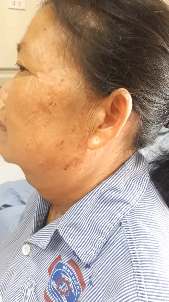 Bệnh nhân V. sau mổ