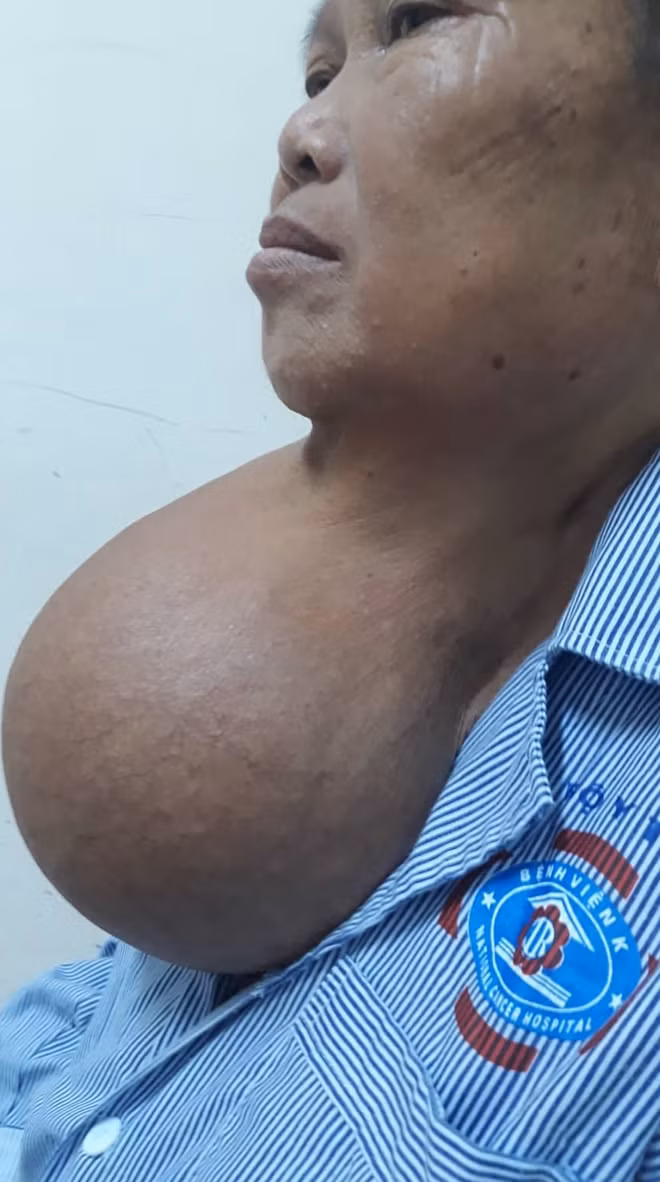 Đeo bướu như quả bưởi suốt hơn 20 năm