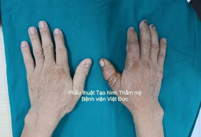 Ngón tay của ông P đã được nối thành công